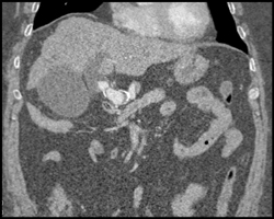 Hepatic Artery Aneurysm - CTisus CT Scan