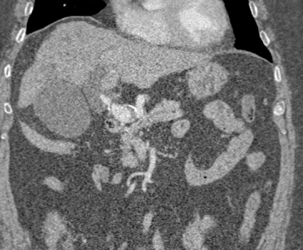 Hepatic Artery Aneurysm - CTisus CT Scan