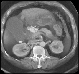 Hepatic Artery Aneurysm - CTisus CT Scan