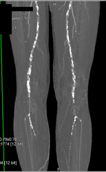 Diseased Superficial Femoral Arteries (SFAs) - CTisus CT Scan