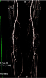 Diseased Superficial Femoral Arteries (SFAs) - CTisus CT Scan