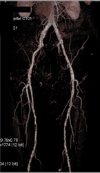 Diseased Superficial Femoral Arteries (SFAs) - CTisus CT Scan