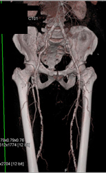 Diseased Superficial Femoral Arteries (SFAs) - CTisus CT Scan