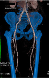 Diseased Superficial Femoral Arteries (SFAs) - CTisus CT Scan