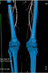 Diseased Superficial Femoral Arteries (SFAs) - CTisus CT Scan