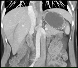 Occluded Right Hepatic Vein - CTisus CT Scan