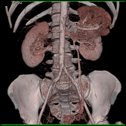 Gonadal Vein Shown With VRT and MIP-see Location of Vessel - CTisus CT Scan