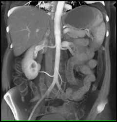 Two Right Renal Arteries - CTisus CT Scan