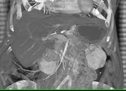 Occluded Celiac Shunt - CTisus CT Scan