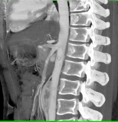 Celiac and SMA Off Common Trunk - CTisus CT Scan