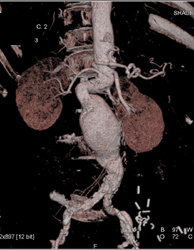 Abdominal Aortic Aneurysm (AAA) - CTisus CT Scan