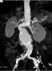 Abdominal Aortic Aneurysm (AAA) - CTisus CT Scan