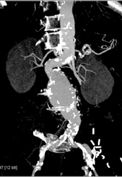 Abdominal Aortic Aneurysm (AAA) - CTisus CT Scan