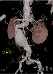 Abdominal Aortic Aneurysm (AAA) With VRT and MIP - CTisus CT Scan