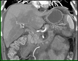 Portal Vein Thrombosis (PVT) With Perfusion Changes and Cavernous Transformation of the Portal Vein (CTPV) - CTisus CT Scan