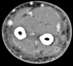 Deep Vein Thrombosis (DVT) in Arm - CTisus CT Scan