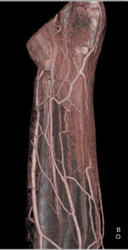 Vessel and Bone Segmentation - CTisus CT Scan