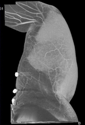 Cellulitis With CTA and Range of Displays - CTisus CT Scan