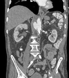 Pseudoaneurysm - CTisus CT Scan