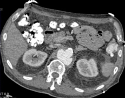 Pseudoaneurysm - CTisus CT Scan