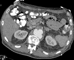 Pseudoaneurysm - CTisus CT Scan