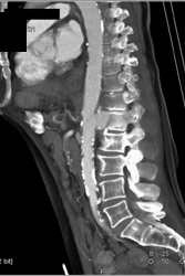 Pseudoaneurysm - CTisus CT Scan