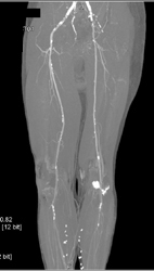 Peripheral Vascular Disease (PVD) - CTisus CT Scan