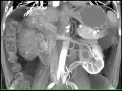 Multiple Left Renal Artery and Veins With MIP and VRT - CTisus CT Scan