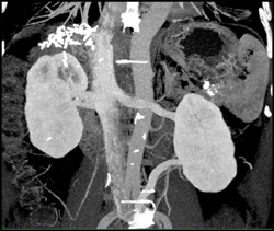 Left Renal Vein Off Iliac Vein - CTisus CT Scan