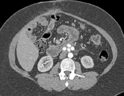 Vascular Shunts for SMA Bypass Seen With 3D Maps - CTisus CT Scan