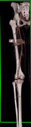 GSW W/o Bleed - CTisus CT Scan