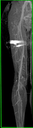 GSW With Run-off Study - CTisus CT Scan