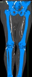 Extensive Peripheral Vascular Disease (PVD) With Bypass Graft - CTisus CT Scan