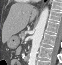 Plaque at Origin of Celiac and SMA - CTisus CT Scan