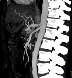 Median Arcuate Ligament Syndrome - CTisus CT Scan