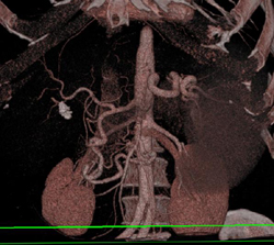 Median Arcuate Ligament Syndrome - CTisus CT Scan