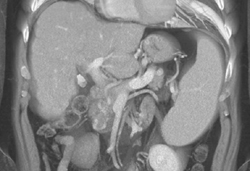 Median Arcuate Ligament Syndrome - CTisus CT Scan