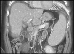 Median Arcuate Ligament Syndrome - CTisus CT Scan