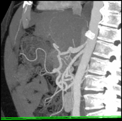 Median Arcuate Ligament Syndrome - CTisus CT Scan