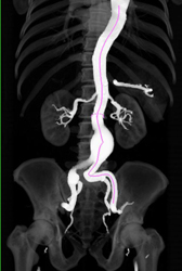 Center Line for Stent - CTisus CT Scan