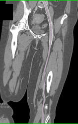 Patent Stent in Superficial Femoral Artery (SFA) - CTisus CT Scan