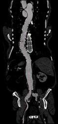 Evaluation of Aortic Aneurysm - CTisus CT Scan