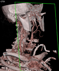 Carotid Stenosis - CTisus CT Scan