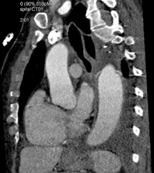 Pseudo Motion Cured By Selecting Correct Phase of Reconstruction - CTisus CT Scan