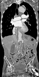 Occlusion of the Abdominal Aorta - CTisus CT Scan