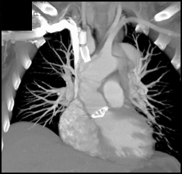 Normal Aortic Valve With Stent in Subclavian Artery - CTisus CT Scan