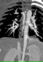 Azygos Arch - CTisus CT Scan