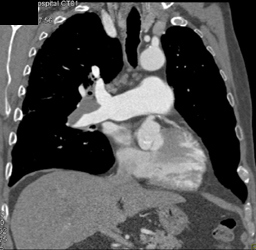 Chronic Pe - CTisus CT Scan