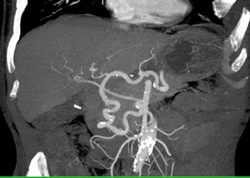 Celiac Stenosis With Collaterals - CTisus CT Scan