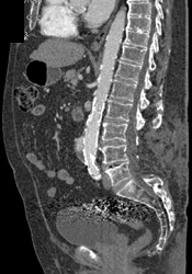 Endoleak - CTisus CT Scan